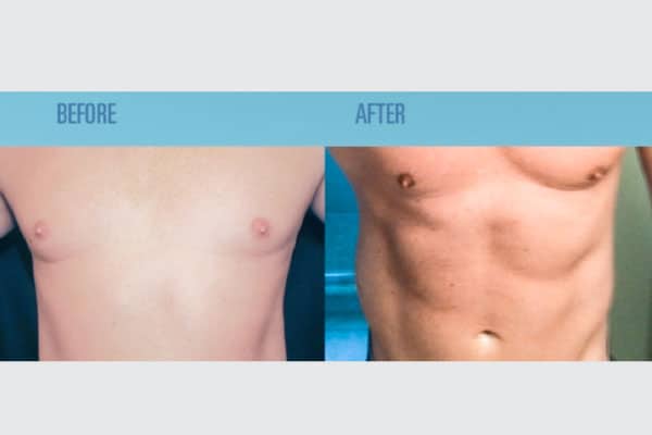 CoolSculpting is the best solution to reduce fat amount by ...