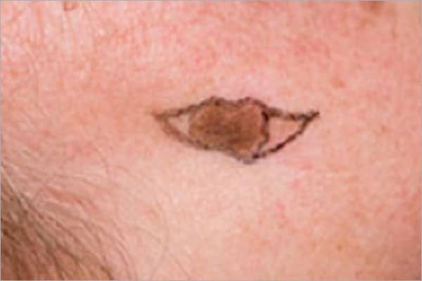 Moles Excision is either for aesthetic reasons or in suspicious of ...