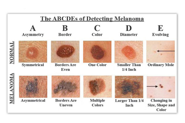 Skin Cancer Prevention, Detection and Treatments