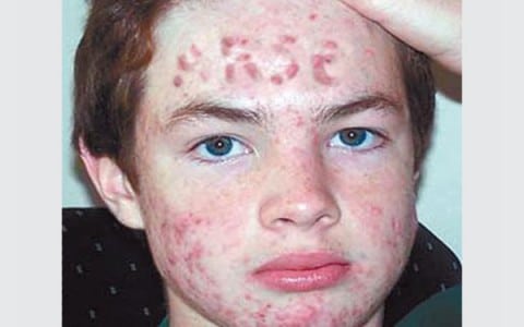 Acne Vulgaris is the most common skin condition that occurs at any age
